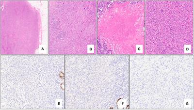 Pathology of Hereditary Breast and Ovarian Cancer